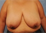 Breast Reduction ( Reduction Mammoplasty) Before & After Gallery
