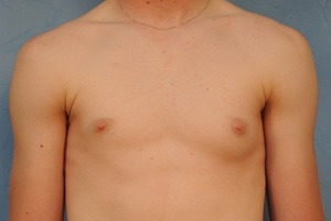 Gynecomastia