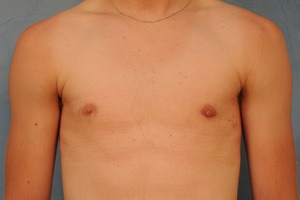 Gynecomastia