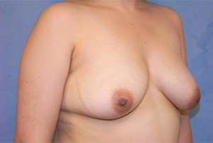 Silicone Breast Augmentation (Augmentation Mammoplasty)