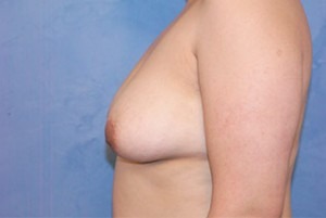 Silicone Breast Augmentation (Augmentation Mammoplasty)