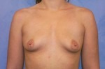 Silicone Breast Augmentation (Augmentation Mammoplasty)