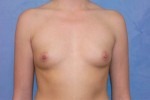 Silicone Breast Augmentation (Augmentation Mammoplasty)