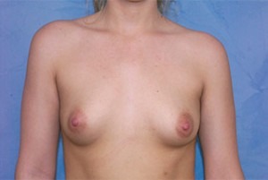 Silicone Breast Augmentation (Augmentation Mammoplasty)