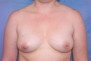 Silicone Breast Augmentation (Augmentation Mammoplasty)