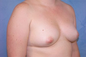 Silicone Breast Augmentation (Augmentation Mammoplasty)