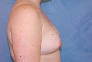 Silicone Breast Augmentation (Augmentation Mammoplasty)