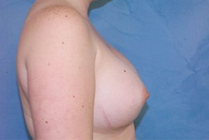 Silicone Breast Augmentation (Augmentation Mammoplasty)