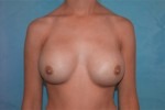 Silicone Breast Augmentation (Augmentation Mammoplasty)