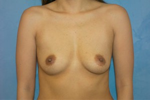 Silicone Breast Augmentation (Augmentation Mammoplasty)