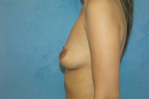 Silicone Breast Augmentation (Augmentation Mammoplasty)