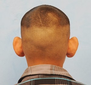 Ear Surgery (Otoplasty)