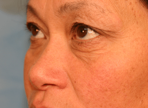Upper Eye Lift (Blepharoplasty)