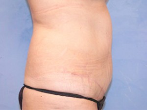 Tummy Tuck (Abdominoplasty)