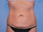 Tummy Tuck (Abdominoplasty)