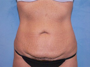 Tummy Tuck (Abdominoplasty)