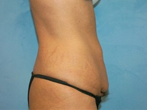 Tummy Tuck (Abdominoplasty)
