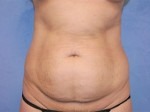 Tummy Tuck (Abdominoplasty)