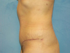 Tummy Tuck (Abdominoplasty)