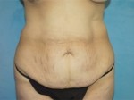 Tummy Tuck (Abdominoplasty)