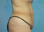 Tummy Tuck (Abdominoplasty)