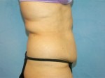 Tummy Tuck (Abdominoplasty)