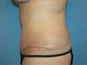 Tummy Tuck (Abdominoplasty)