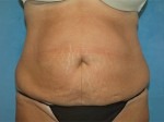 Tummy Tuck (Abdominoplasty)