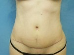 Tummy Tuck (Abdominoplasty)