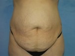 Tummy Tuck (Abdominoplasty)