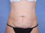Tummy Tuck (Abdominoplasty)