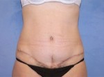 Tummy Tuck (Abdominoplasty)