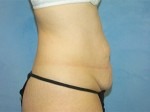 Tummy Tuck (Abdominoplasty)
