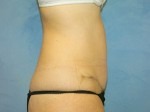 Tummy Tuck (Abdominoplasty)