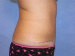Tummy Tuck (Abdominoplasty)