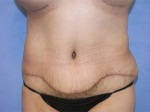 Tummy Tuck (Abdominoplasty)