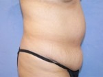 Tummy Tuck (Abdominoplasty)
