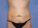 Tummy Tuck (Abdominoplasty)