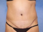 Tummy Tuck (Abdominoplasty)