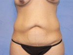 Tummy Tuck (Abdominoplasty)