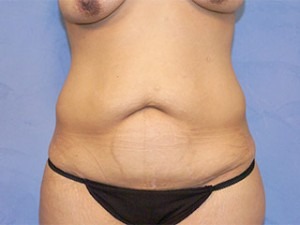 Tummy Tuck (Abdominoplasty)