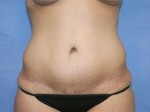 Tummy Tuck (Abdominoplasty)