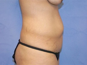 Tummy Tuck (Abdominoplasty)
