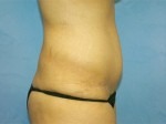 Tummy Tuck (Abdominoplasty)