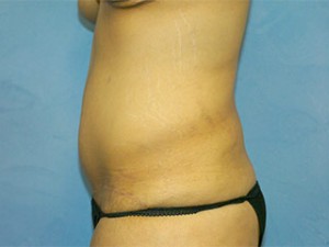 Tummy Tuck (Abdominoplasty)