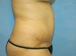 Tummy Tuck (Abdominoplasty)
