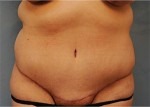 Tummy Tuck (Abdominoplasty)