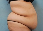 Tummy Tuck (Abdominoplasty)