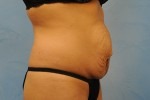 Tummy Tuck (Abdominoplasty)