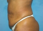 Tummy Tuck (Abdominoplasty)